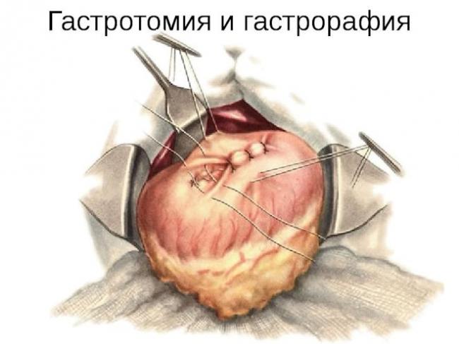 Что можно кушать после операции язвы желудка