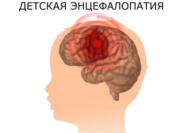 Энцефалопатия головного мозга – что это такое? резидуальная, алкогольная, токсическая, перинатальная, посттравматическая энцефалопатия