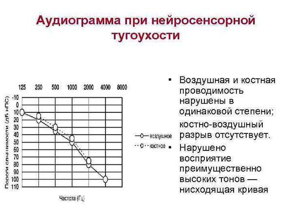 Лечение и разновидности сенсоневральной тугоухости всех степеней