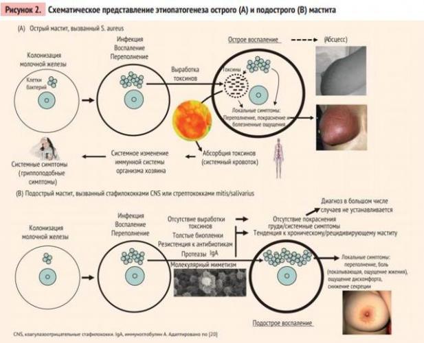 Мастит. симптомы, причины, диагностика и лечение болезни :: polismed.com