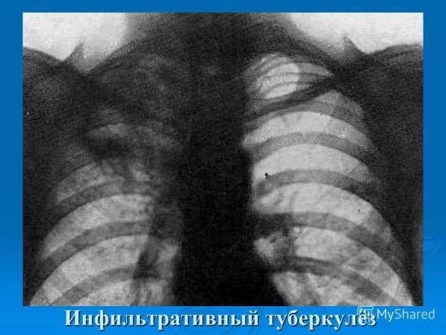 Очаговый туберкулез легких: особенности и лечение