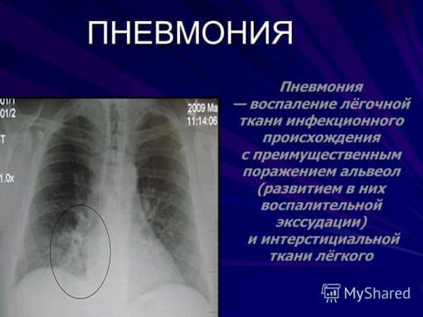 Может ли быть воспаление легких без температуры