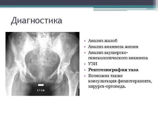 Симфизит при беременности - запись пользователя мария (kotka123) в сообществе здоровье будущей мамы и малыша в категории боли, орви, грипп - babyblog.ru