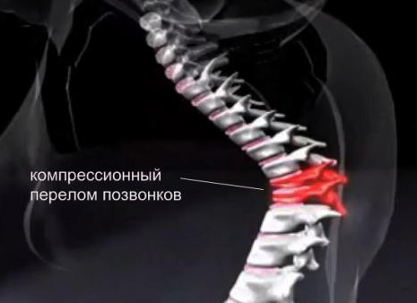 Лечение и последствия у взрослых с компрессионным переломом позвоночника грудного отдела