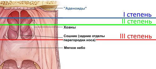 Аденоиды у детей: симптомы и лечение без операции, самые эффективные средства