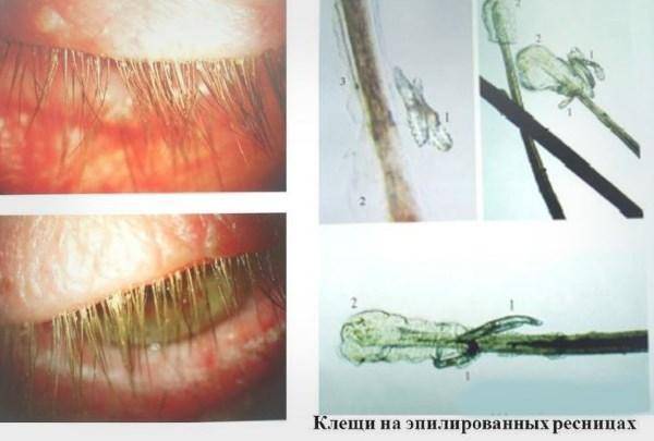 Демодекоз век: лечение и симптомы у человека, фото заболевания, как вылечить с помощью народных средств, а также какую мазь и глазные капли использовать