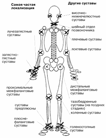 Лечение остеоартроза