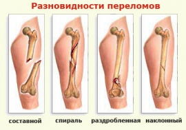 Диета при переломах костей ног