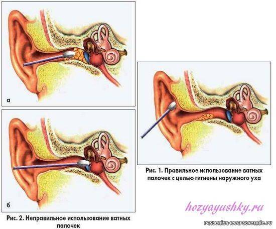 Как пробить ушную пробку в домашних условиях