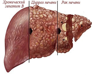 Необъяснимое истощение и плохой аппетит. что такое фиброз печени?