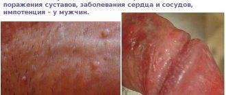 Хламидиоз: признаки у мужчин и женщин, методы лечения