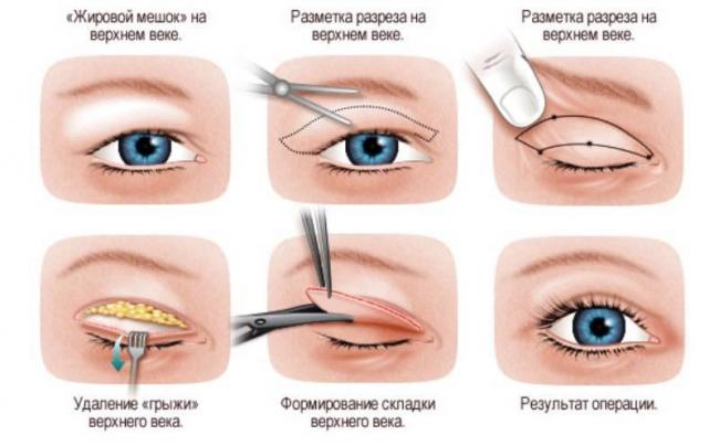Отеки верхних век причины лечение народными средствами