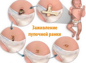 Пупок кровит у новорожденного - пупок у новорожденного кровит - запись пользователя белла (belochkaislon) в сообществе здоровье новорожденных в категории разное - babyblog.ru