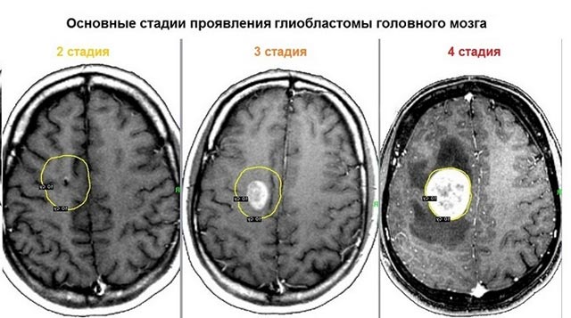 Выживаемость при глиобластоме