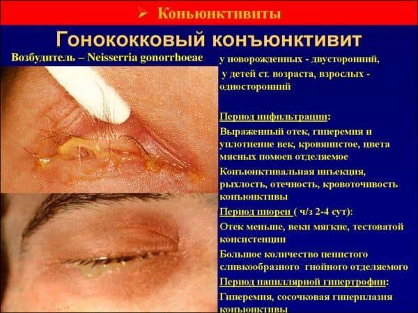 Конъюнктивит через сколько дней не заразен