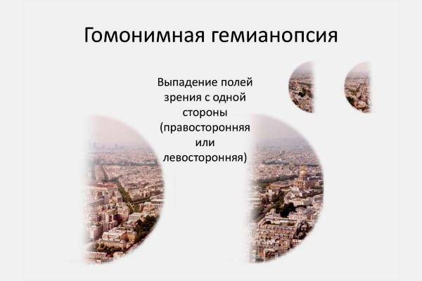 Лечение гемианопсии после инсульта