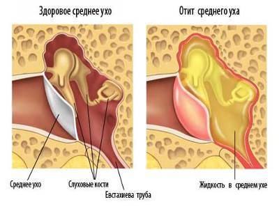 Самые эффективные антибиотики для детей при отите