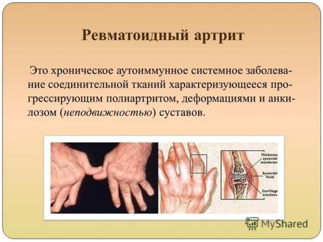 Остеоартрит – болезнь изношенных суставов