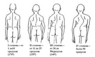 Правильные упражнения при сколиозе для 1, 2, 3 степени