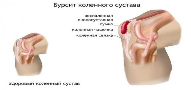 Синовит коленного сустава: симптомы и лечение, что это, причины болезни