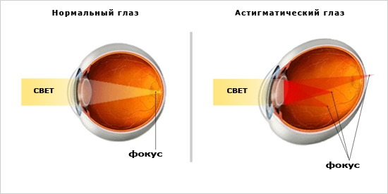 Заболевание органов зрения – миопический астигматизм