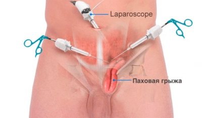 Питание после удаления паховой грыжи