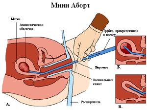 Что можно и нельзя после аборта: реабилитация, выделения, половая жизнь, боли, восстановление цикла