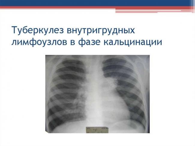 Туберкулез внутригрудных лимфатических узлов (бронхоадениты) - описание болезни