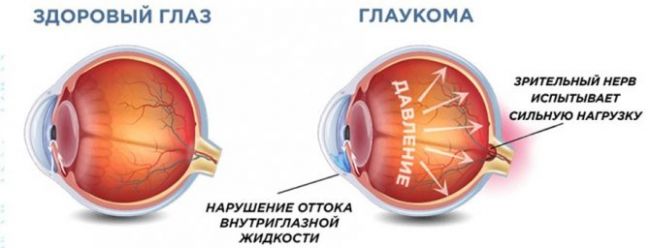 5 основных симптомов внутриглазного давления