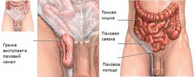 Какие продукты можно есть после удаления паховой грыжи?