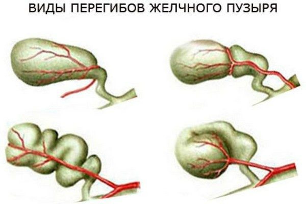 Загиб желчного пузыря — симптомы и лечение