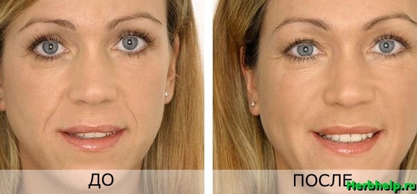 Преимущества hyaluron pen - vbg-cosmetic