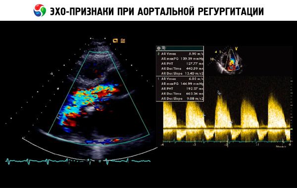 Что такое регургитация 1 степени