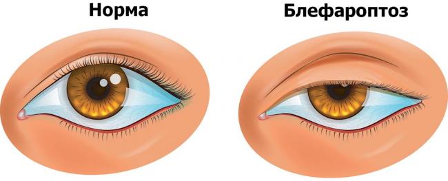Птоз, опущение верхнего века: причины и лечение, операция