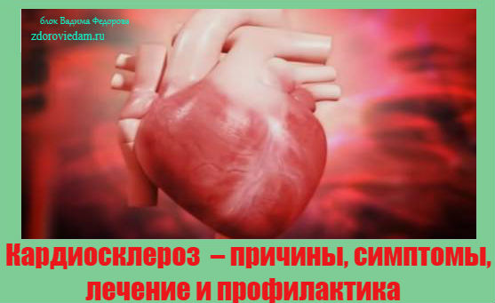 Что же такое атеросклеротический кардиосклероз в ибс