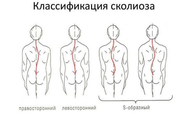 Как лечить сколиоз 2 степени у взрослых