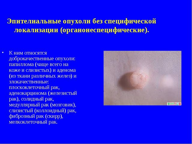 Зубчатая аденома толстой кишки