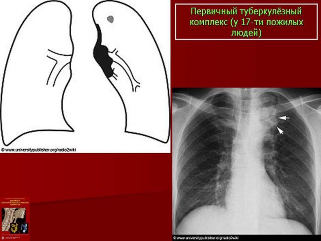 Туберкулезная интоксикация — детей, подростков и взрослых