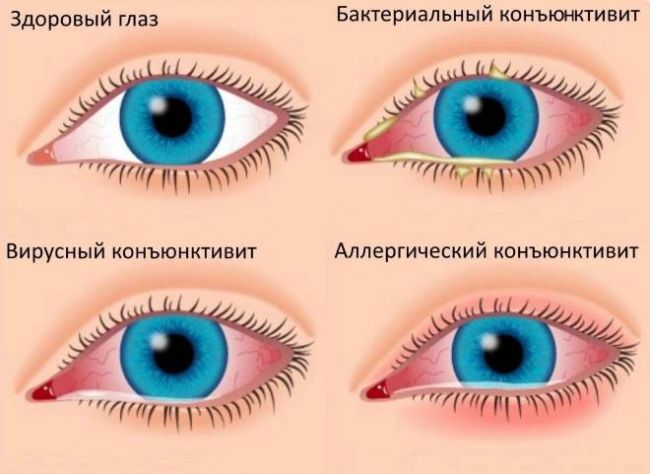 Отек верхнего века у переносицы