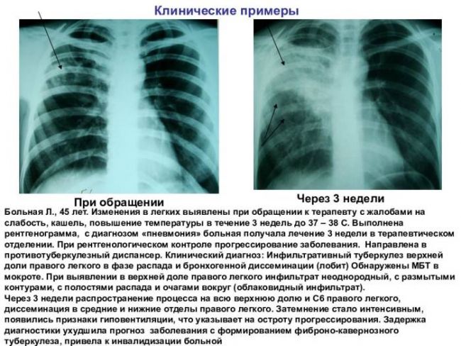 Что такое инфильтративный туберкулез легкого, заразен он или нет? симптомы, лечение, диагностика