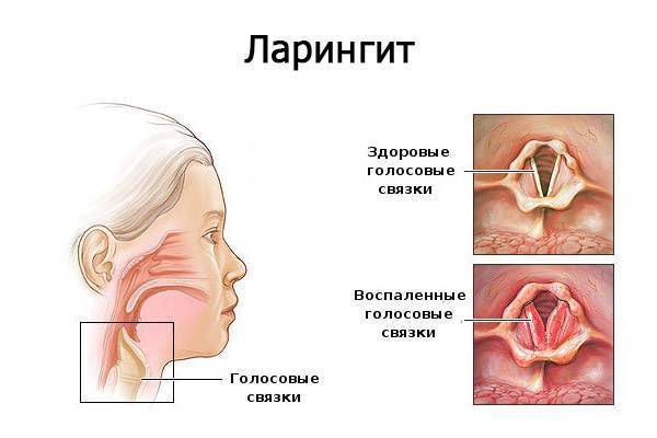 Заболевания глотки и гортани: как различить и чем лечить