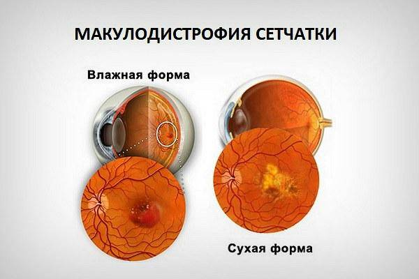 Народные средства лечения при дистрофии макулы глаза