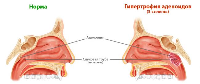 Насморк у детей при аденоидах: эффективное лечение