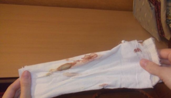 Выделения из половых путей после кесарева сечения: где граница между нормой и патологией?
