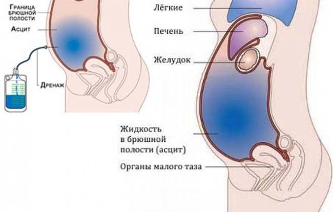 Лапароцентез: показания, подготовка, техника процедуры, результат и реабилитация