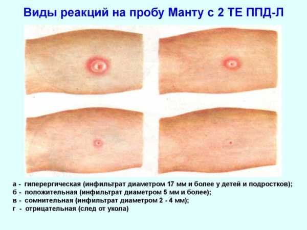 Что делать, если реакция манту положительная?