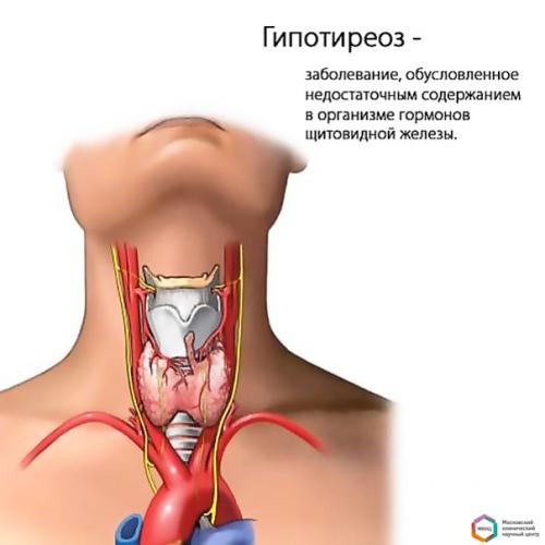 Симптомы и лечение гипотиреоза у женщин