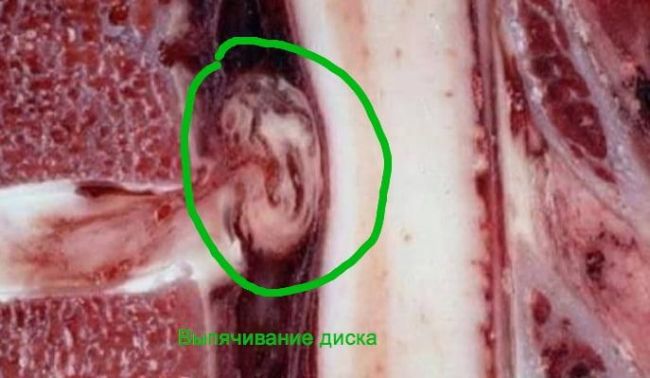 Симптомы и лечение грыжи позвоночника