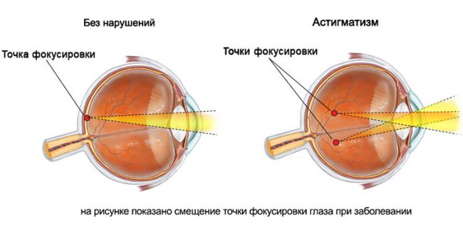 Миопия высокой степени: методы лечения, ограничения при миопии