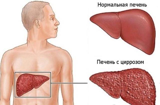 О чем говорит боль при кашле, возникающая в подреберье?